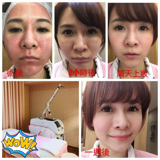 【皮秒雷射】期待已久的皮秒終於來了